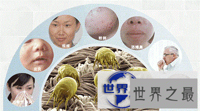 【图】知道脸上痘痘的罪魁祸首是螨虫，但是你见过螨