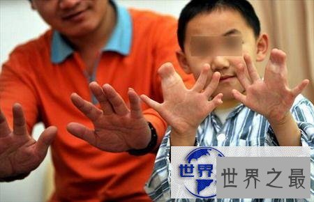 【图】世界手指和脚趾最多的人,15个手指/16个脚趾