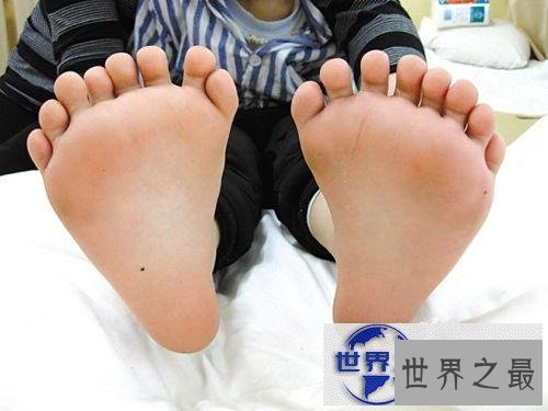 【图】世界手指和脚趾最多的人,15个手指/16个脚趾