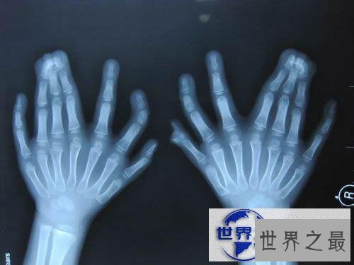 【图】世界手指和脚趾最多的人,15个手指/16个脚趾