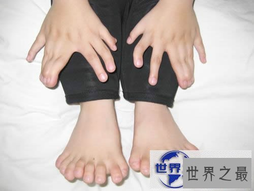 【图】世界手指和脚趾最多的人,15个手指/16个脚趾